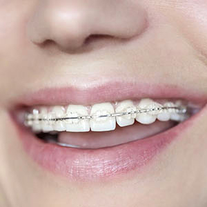 The Form of Braces People May Not Know About: Ceramic Braces