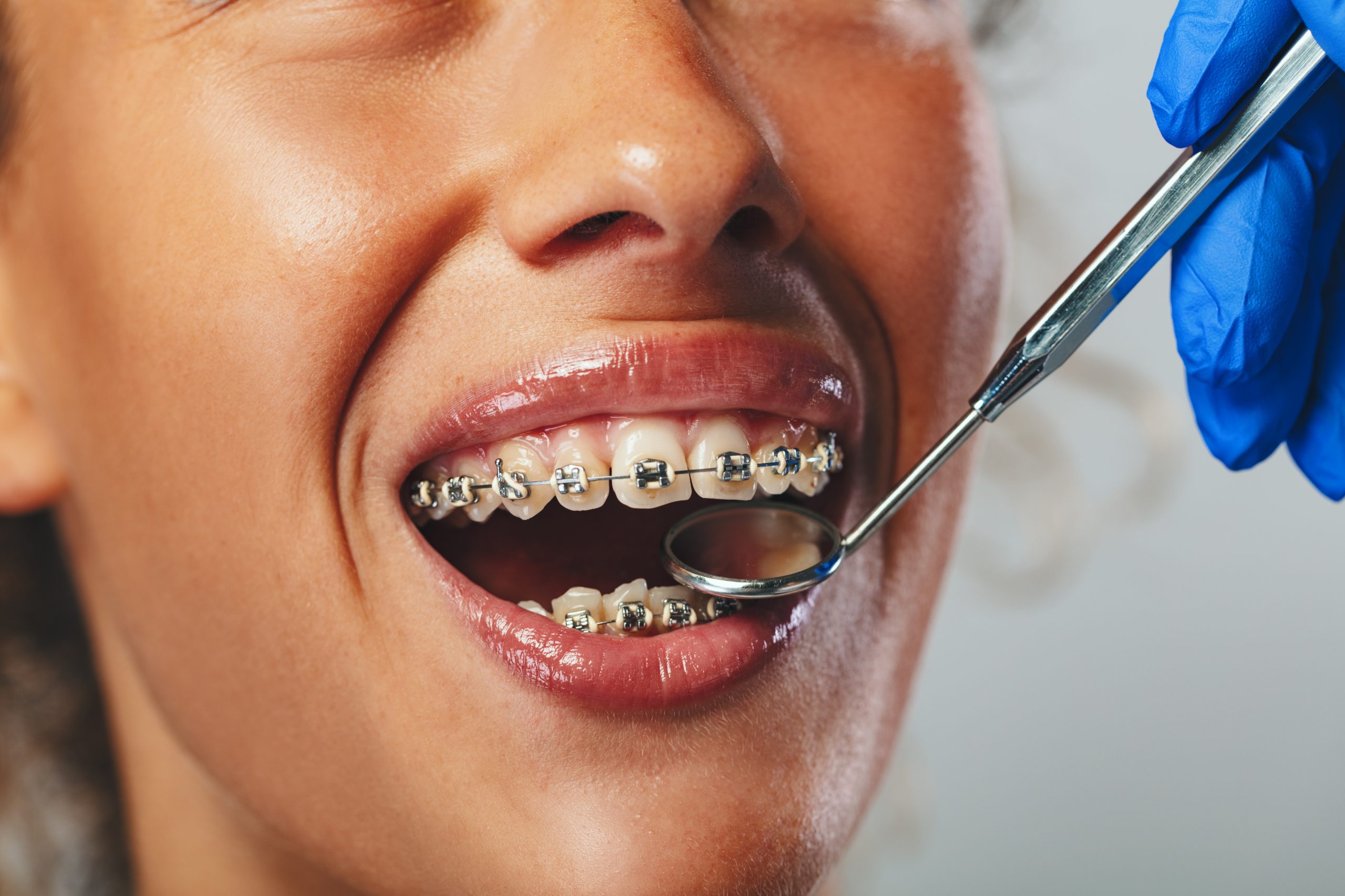 Close-up of a dentist checking braces with a dental mirror on the young smiling female patient.